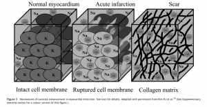 図２　LGE陽性の原理　　 文献[12]　より引用